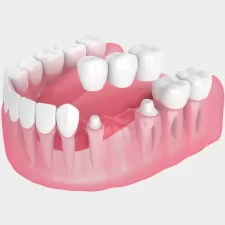 The Latest Advances in Dental Bridge Technology for East York Patients