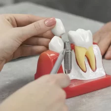 How to Care for Dental Implants to Ensure Long-Term Success