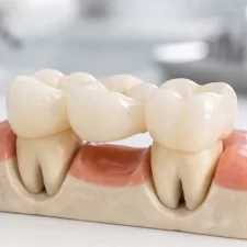 How Modern Digital Dentistry Improves the Fit and Comfort of Dental Bridges
